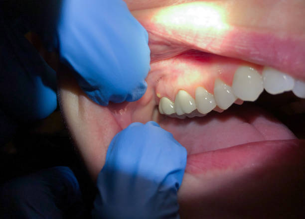 Best Emergency Dental Care for Abscessed Tooth in Greencastle, IN
